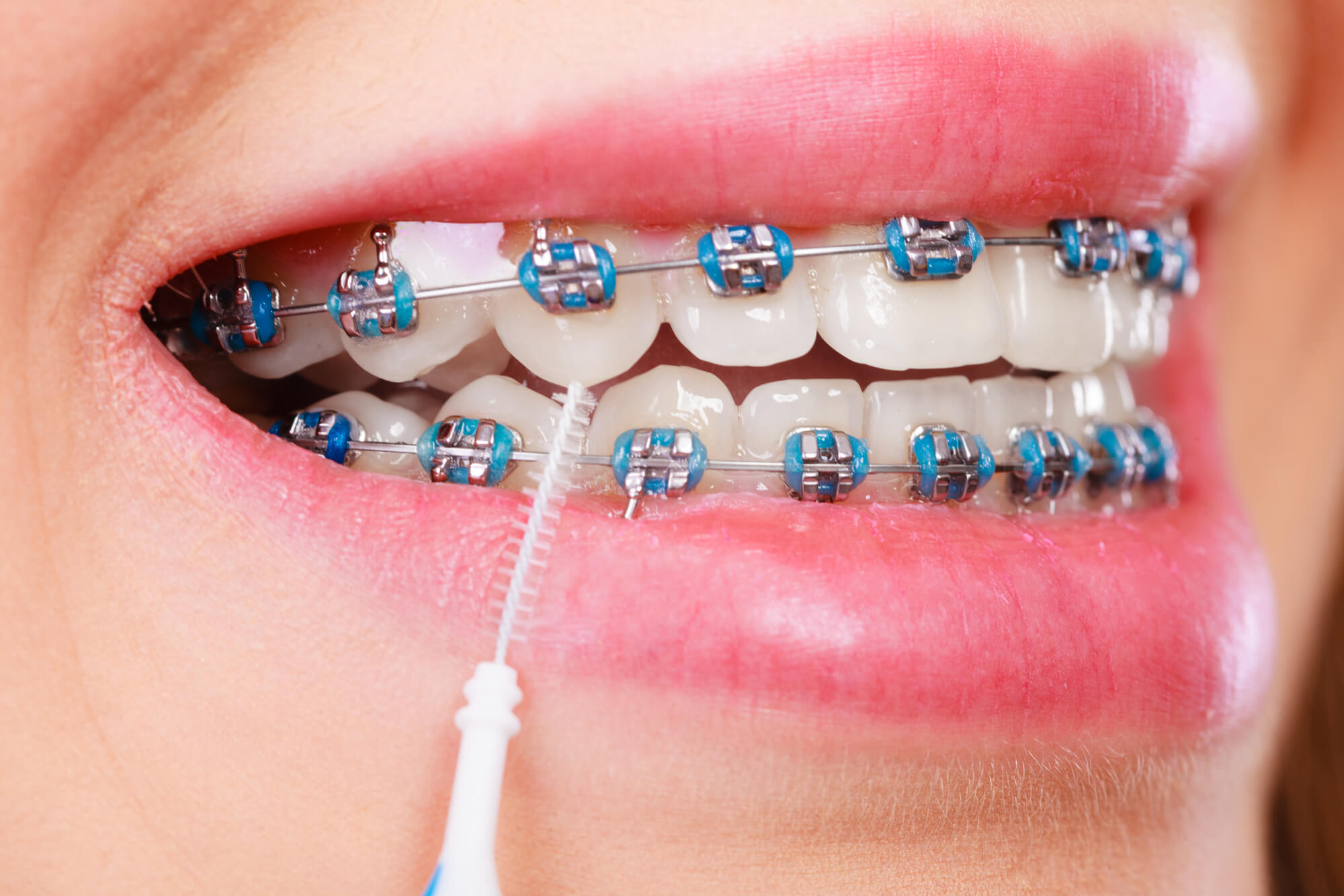 https://doutorsantoandre.com.br/odontologia/wp-content/uploads/2019/01/aparelho-ortodontico.jpg