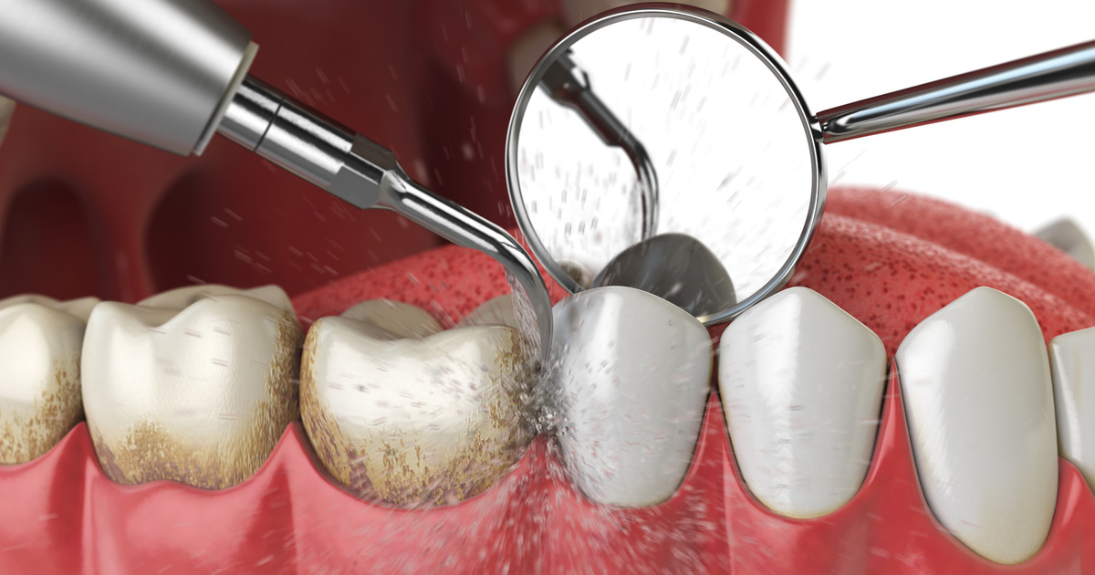 Limpeza dental: porque ir ao dentista a cada 6 meses - Dr. Santo André
