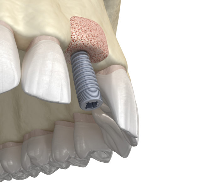 Você sabe o que é um enxerto ósseo dentário?