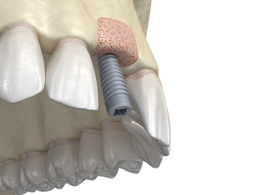 Você sabe o que é um enxerto ósseo dentário?